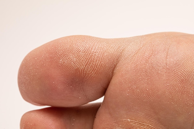 Calluses and thick dehydrated skin under the big toe of a\
female foot