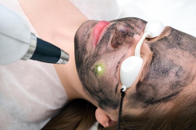 Foto peeling al carbonio del viso di una giovane bella donna. peeling rinnovamento della pelle. punto laser sul viso.
