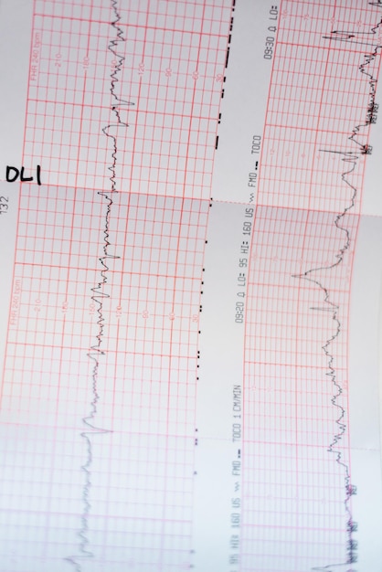 Cardiogram of the baby before birth