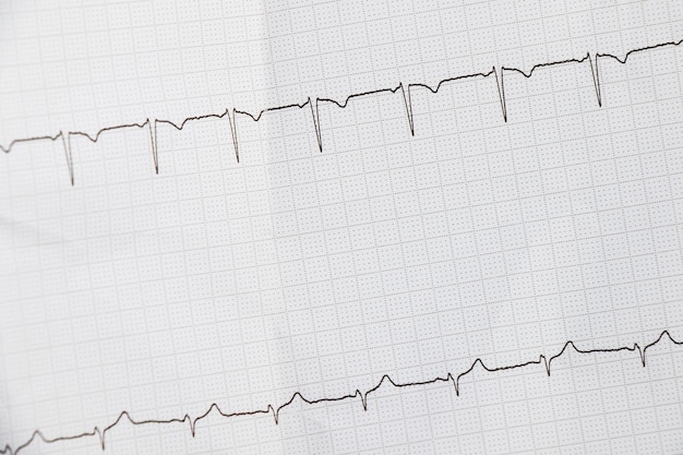 Foto cardiogramgolven van de hartslag ekg op het papier aritmie