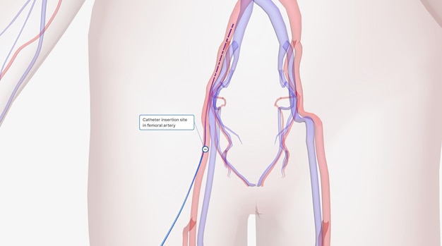 写真 大腿動脈のカテーテル挿入部位