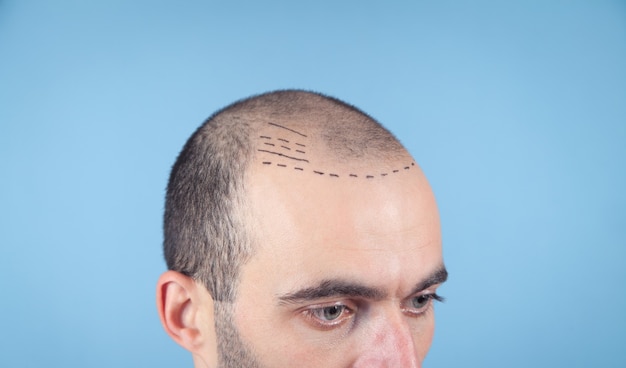Photo caucasian bald man. before hair transplantation