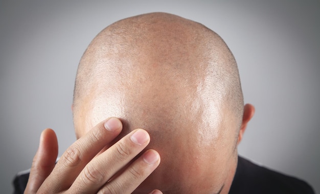 Caucasian bald man. Before hair transplantation