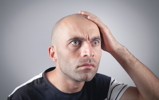 Caucasian bald man in office. Hair loss concept