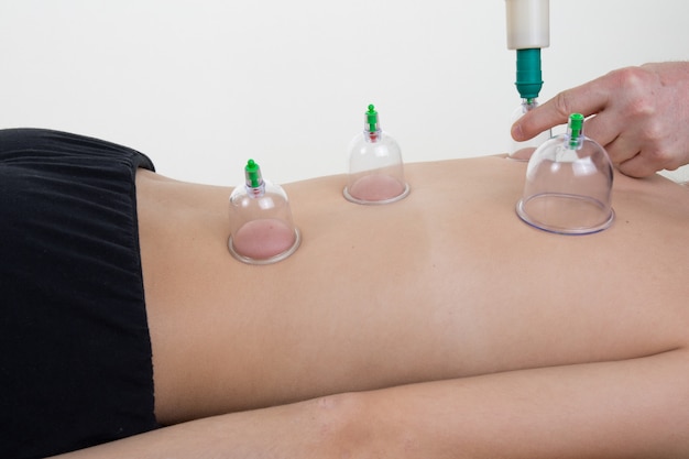 Caucasian female laying and get a cupping therapy