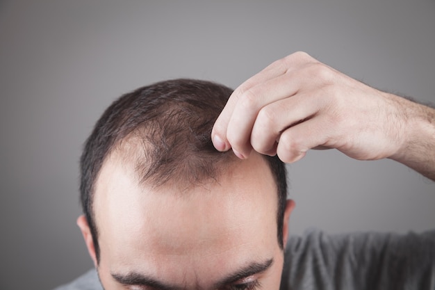 Photo caucasian man checking his hair. hair loss problem