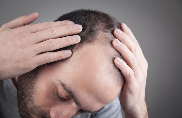 Uomo caucasico che controlla i suoi capelli. problema di caduta dei capelli