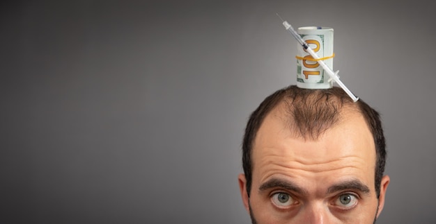 Foto uomo caucasico con una siringa e denaro soldi per il trapianto di capelli problema di perdita dei capelli