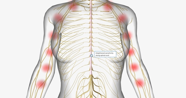 Photo central sensitization also called central pain is a condition associated with the development of chronic pain