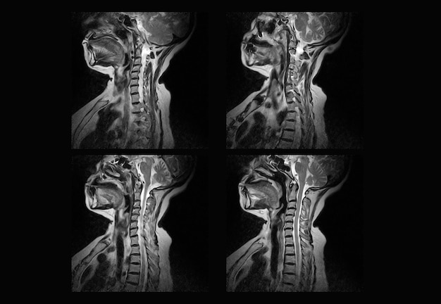 Cervicale wervelkolom MRI en ct-scan röntgenfoto's professioneel