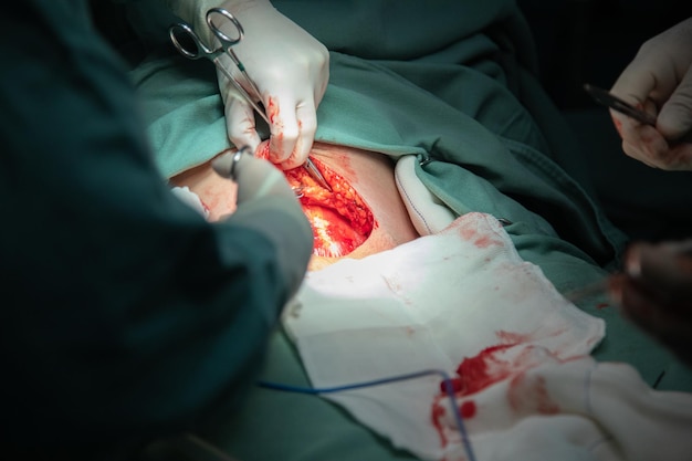 Photo cesarean delivery procedure in hospital