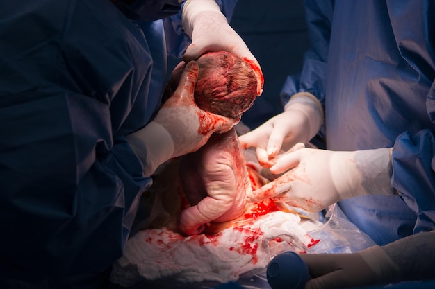 Cesarean section the operation is in process