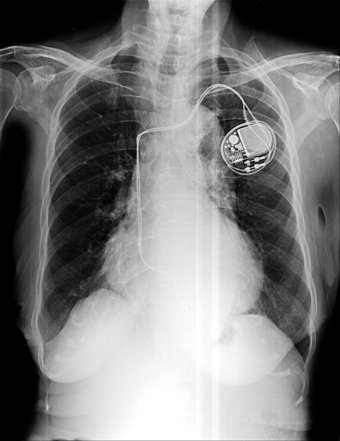 Photo a chest radiograph with a device labeled as a ` ` heart''