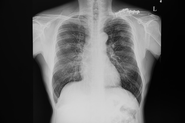 Chest xray film of a patient with fractured clavicle