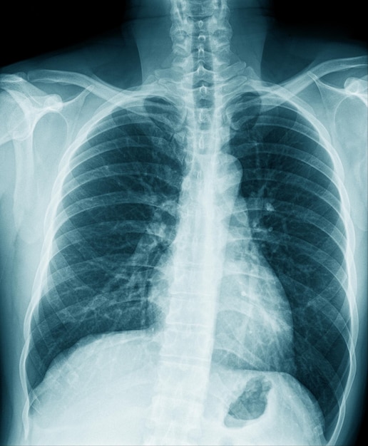 Рентгенограмма грудной клетки в голубых тонах