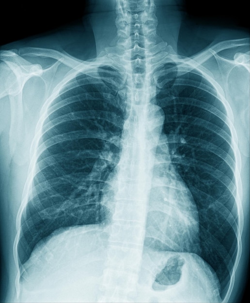 Chest xray image in blue tone