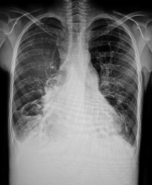 Photo a chest xray showing the xray and xrays.