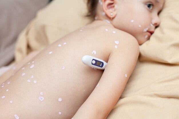 Chickenpox. Fever. A girl suffering from chickenpox lies on a bed with a thermometer. rash. High quality photo