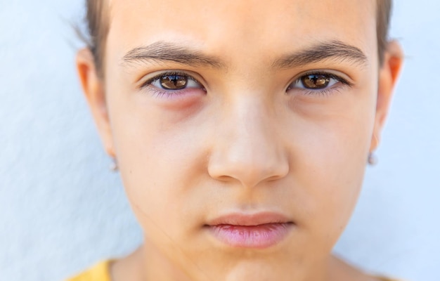 The child eye is inflamed Selective focus