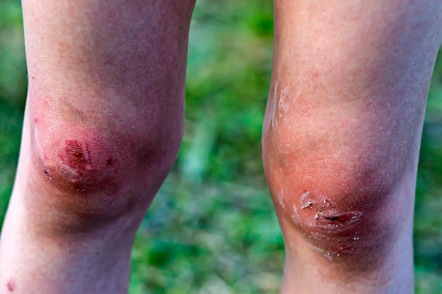 Children's broken knees blood from wounds