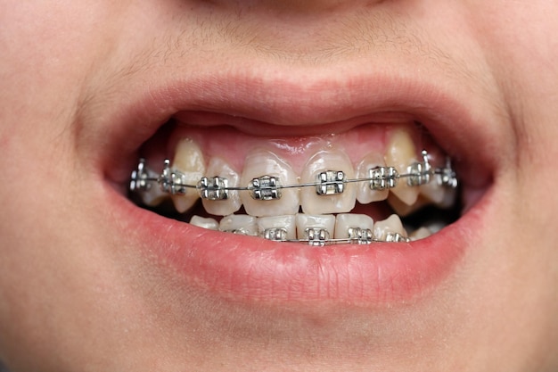 Children teeth with braces