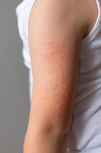 childs arm with red rash