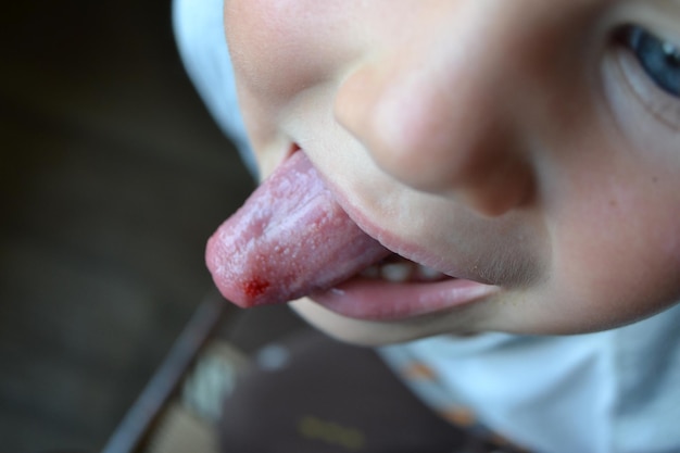 Childs bitten tongue closeup of lips tongue protrusion of blood