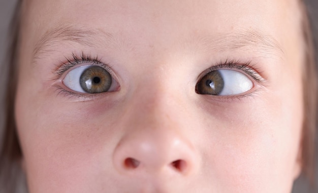 Childs face with squint and freckles on nose