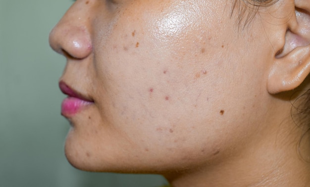 Chloasma of melasma zwarte vlekken en acnelittekens