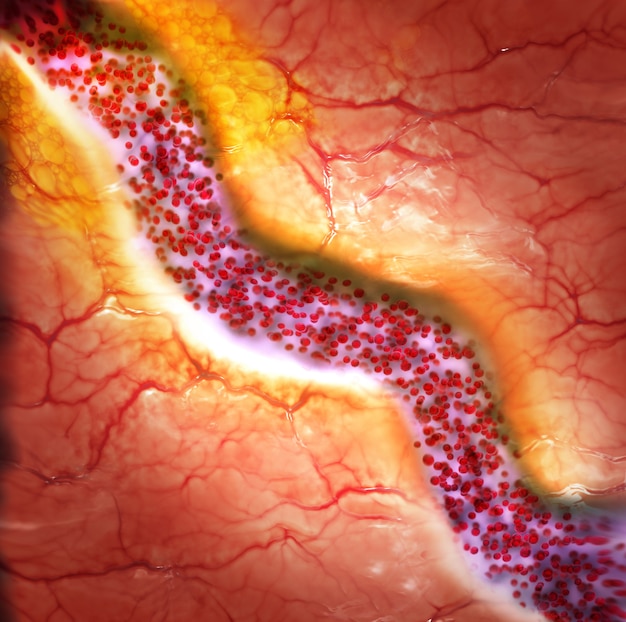 Cholesterol plaque in blood vessel