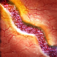 Photo cholesterol plaque in blood vessel