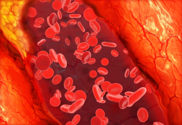 Cholesterolplaque in bloedvat