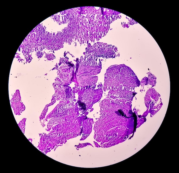 Chronic ileitis or inflammation of the ileum caused by Crohn's disease or inflammatory bowel disease