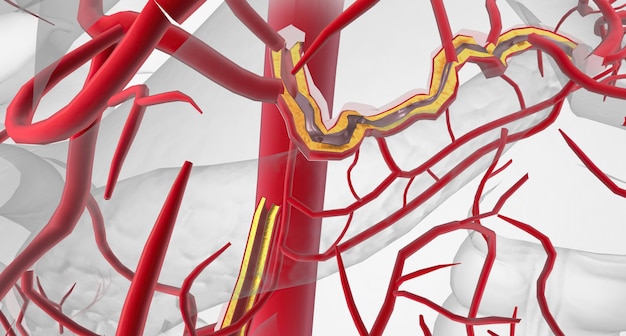 Foto l'ischemia mesenterica cronica è una diminuzione del flusso sanguigno a causa del restringimento del vaso principale che alimenta l'intestino