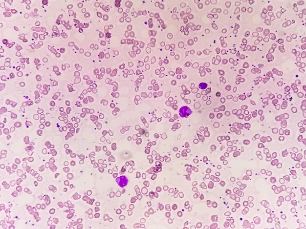 Chronic myeloid leukemia in accelerated phase with thrombocytosis Chronic myelogenous leukemia CML