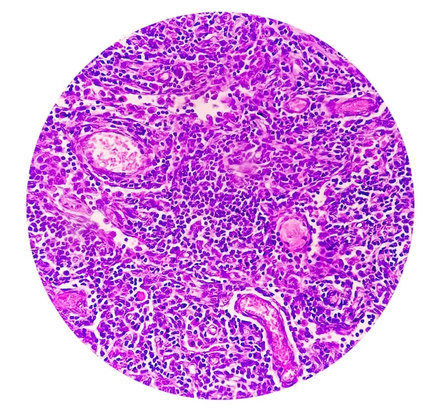 Chronische granulomateuze ontsteking van tbc of tuberculose of epithelioïde histiocyten