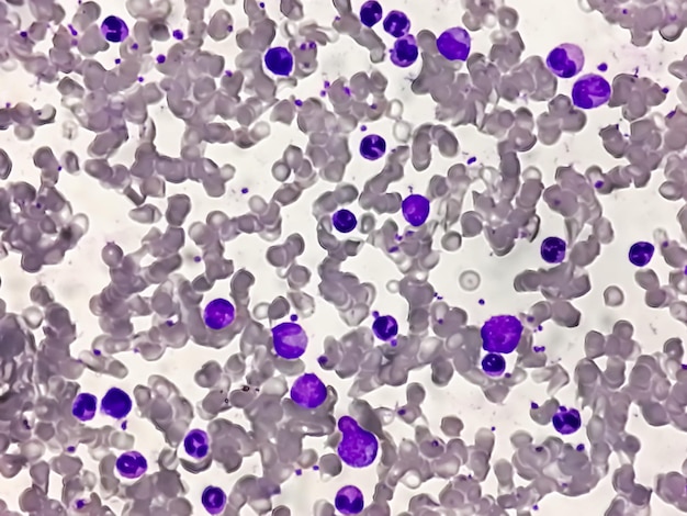 Chronische myeloïde leukemie (CML) of chronische myeloïde leukemie een kanker van de witte bloedcellen.