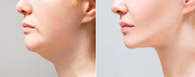 a close portrait of an aged woman before and after facial rejuvenation procedure correction of the chin shape liposuction of the neck the result of the procedure in the clinic of aesthetic medicine