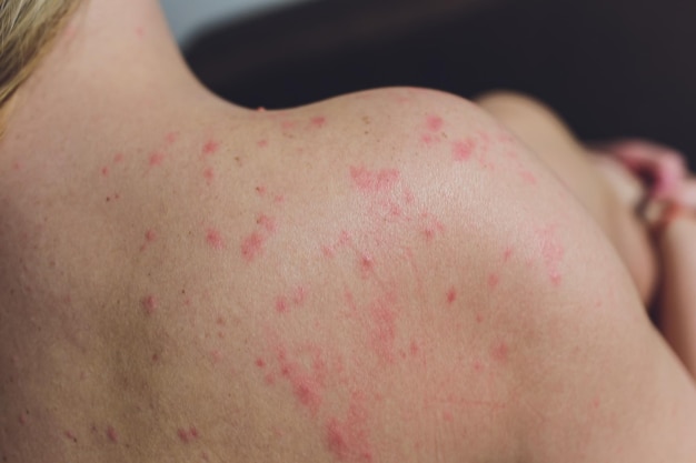 Close up allergie uitslag rond achteruitzicht van mens met dermatitis probleem van uitslag allergie uitslagen en