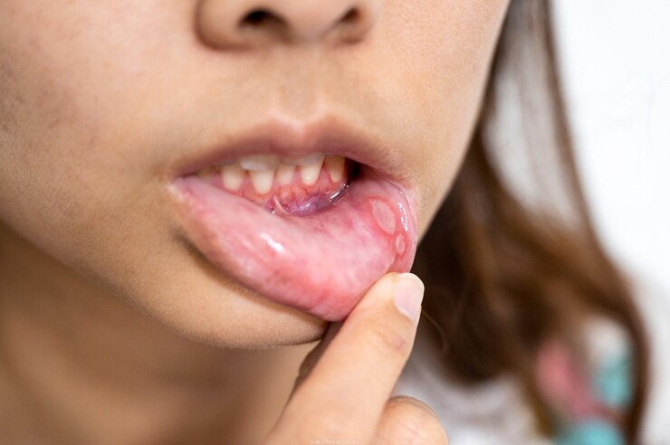 Photo close-up asian woman have aphthous ulcer or canker sore on mouth at lip