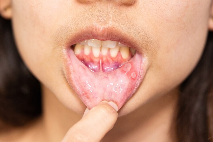 Photo close-up asian woman have aphthous ulcer or canker sore on mouth at lip