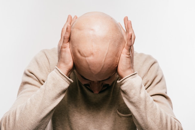 Close up of bald male head after oncology operation