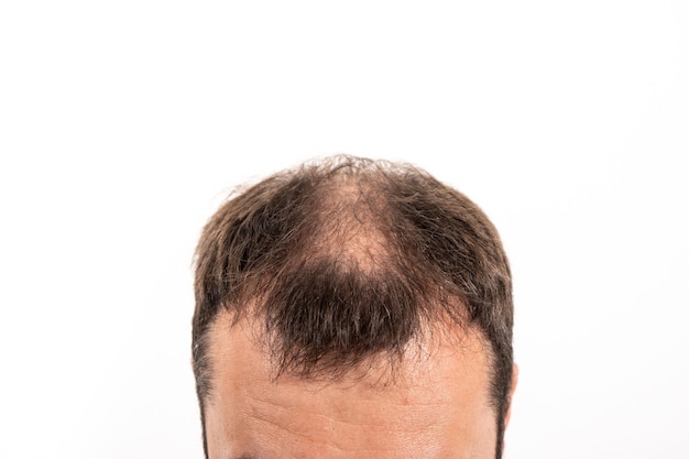 Close-up balding head of a young man on a white isolated background.