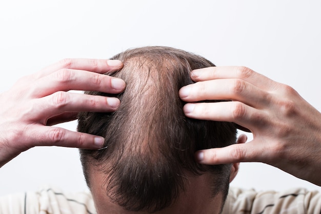 Close-up balding head of a young man on a white isolated background.