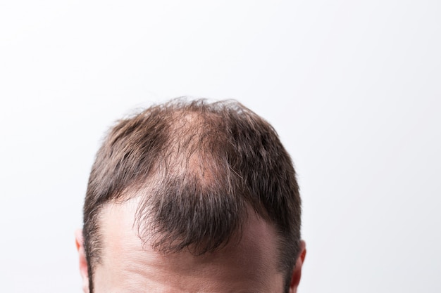 Close-up balding head of a young man