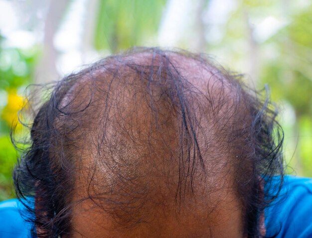 Photo close-up of balding man