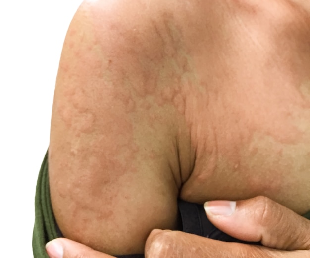 Close-up beeld van lichaam een vrouw een insectensteek Met ernstige allergische huiduitslag