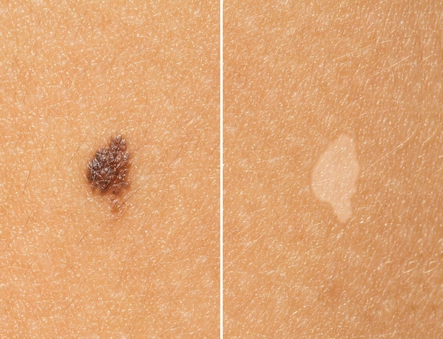 A close up before and after view of a skin mole removal Results after successful surgery to remove