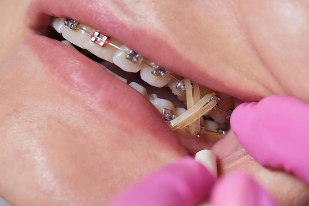 Close-up beugels op tanden met elastische orthodontische behandeling Front view tandheelkundige beugels