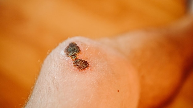Вблизи кровоточащие царапины колени синяки на коже вблизи травма рана высушена